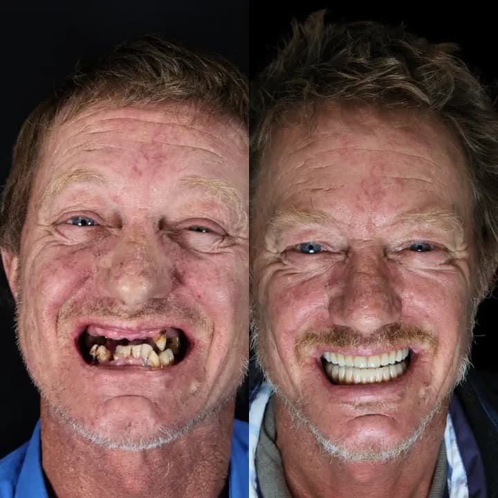 Azure Dental patient — before and after