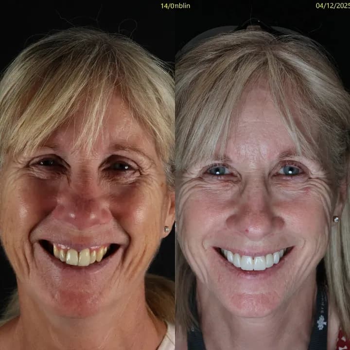 Azure Dental patient — before and after