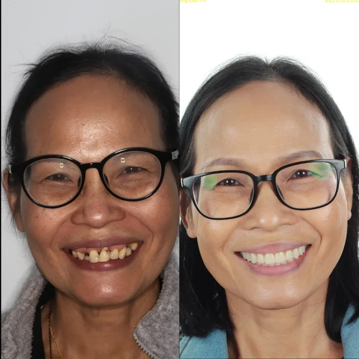 Azure Dental patient — before and after