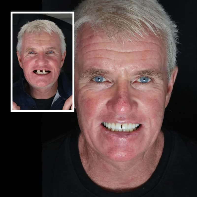 Azure Dental patient — before and after dental work